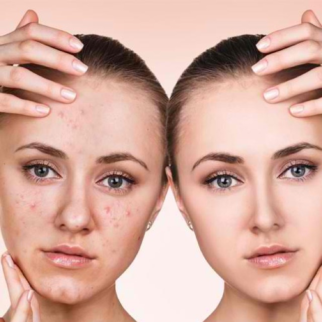 Acne treatment