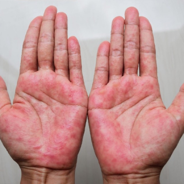 Eczema treatment