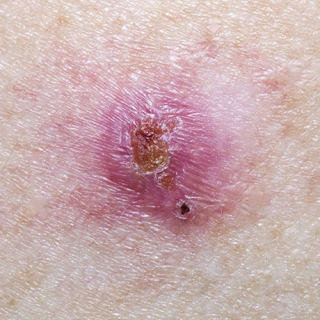 Skin cancer care
