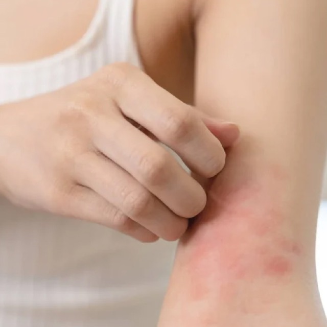 Dermatitis treatment