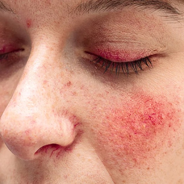 Rosacea treatment