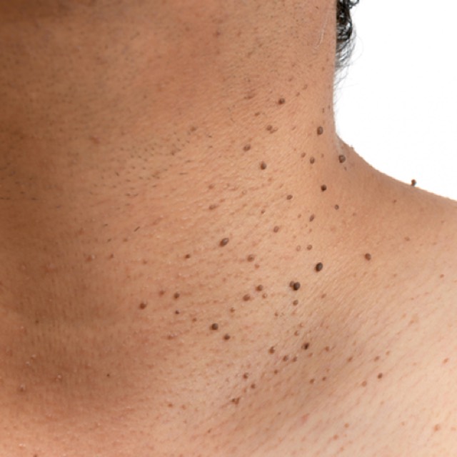 Skin tags