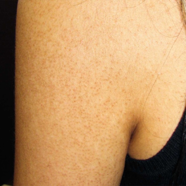 Keratosis pilaris