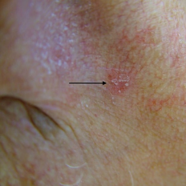 Actinic keratoses