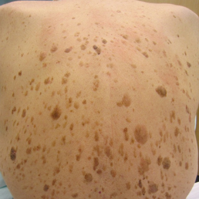 Seborrheic keratoses
