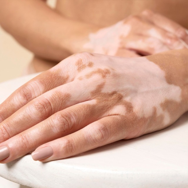 Vitiligo treatment
