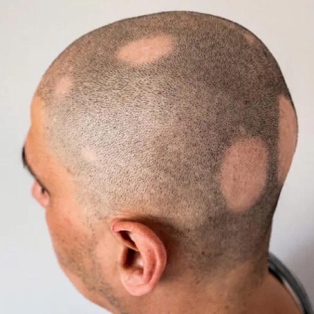 Alopecia areata treatment