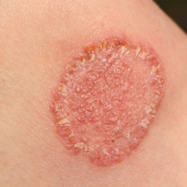 Fungal infections