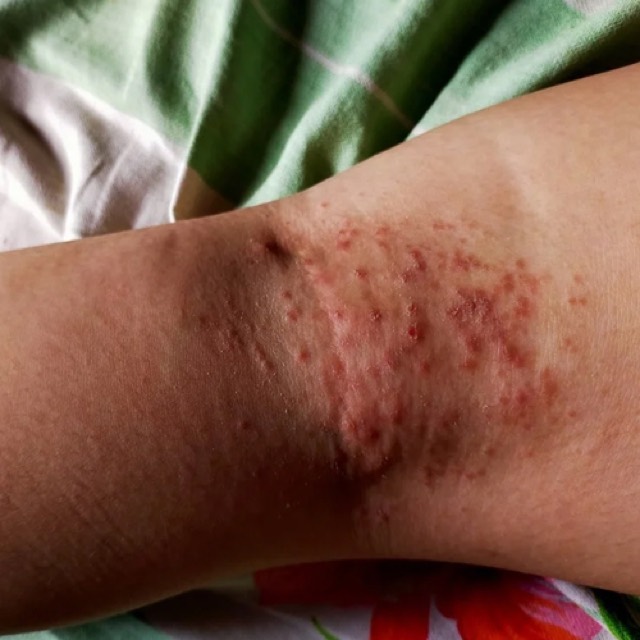 Bacterial infections