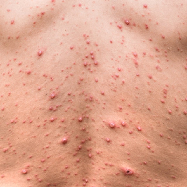 Viral infections