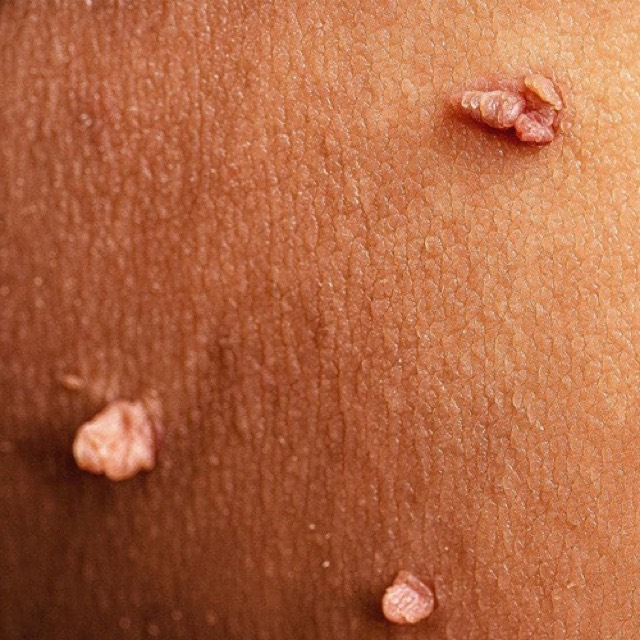 Warts