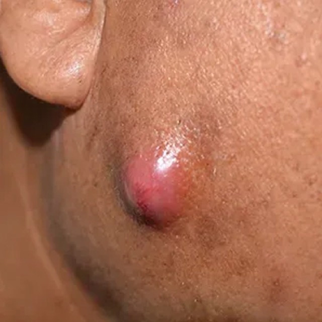 Cysts